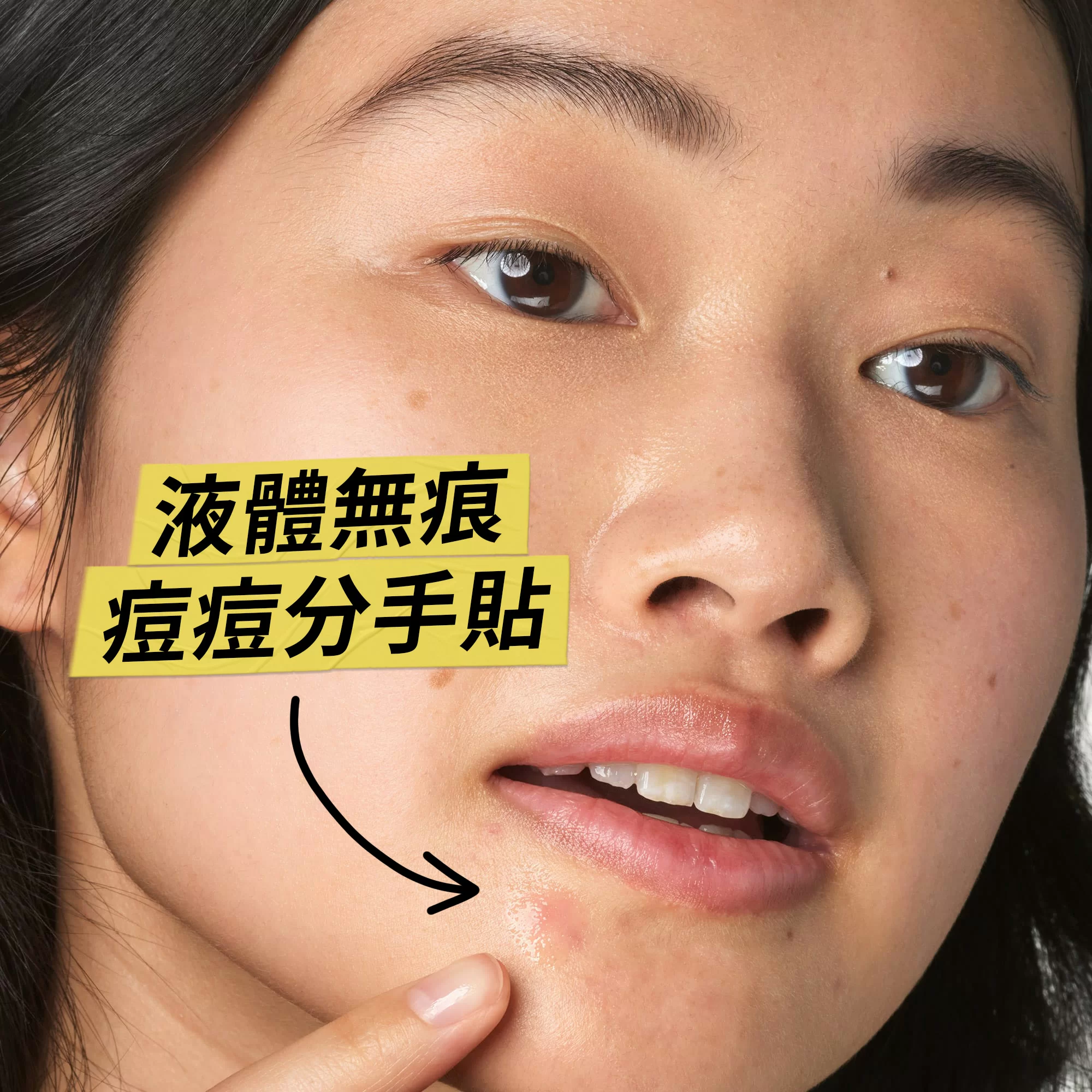 醫學水楊酸抗粉刺精華液體貼